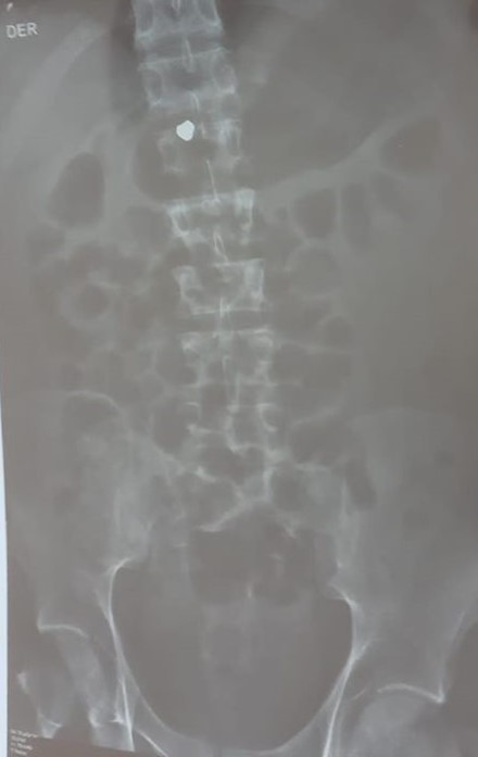 Radiografía donde se observa un perdigón, que se cree que es de plomo, alojado en la médula espinal de Jon Cordero.