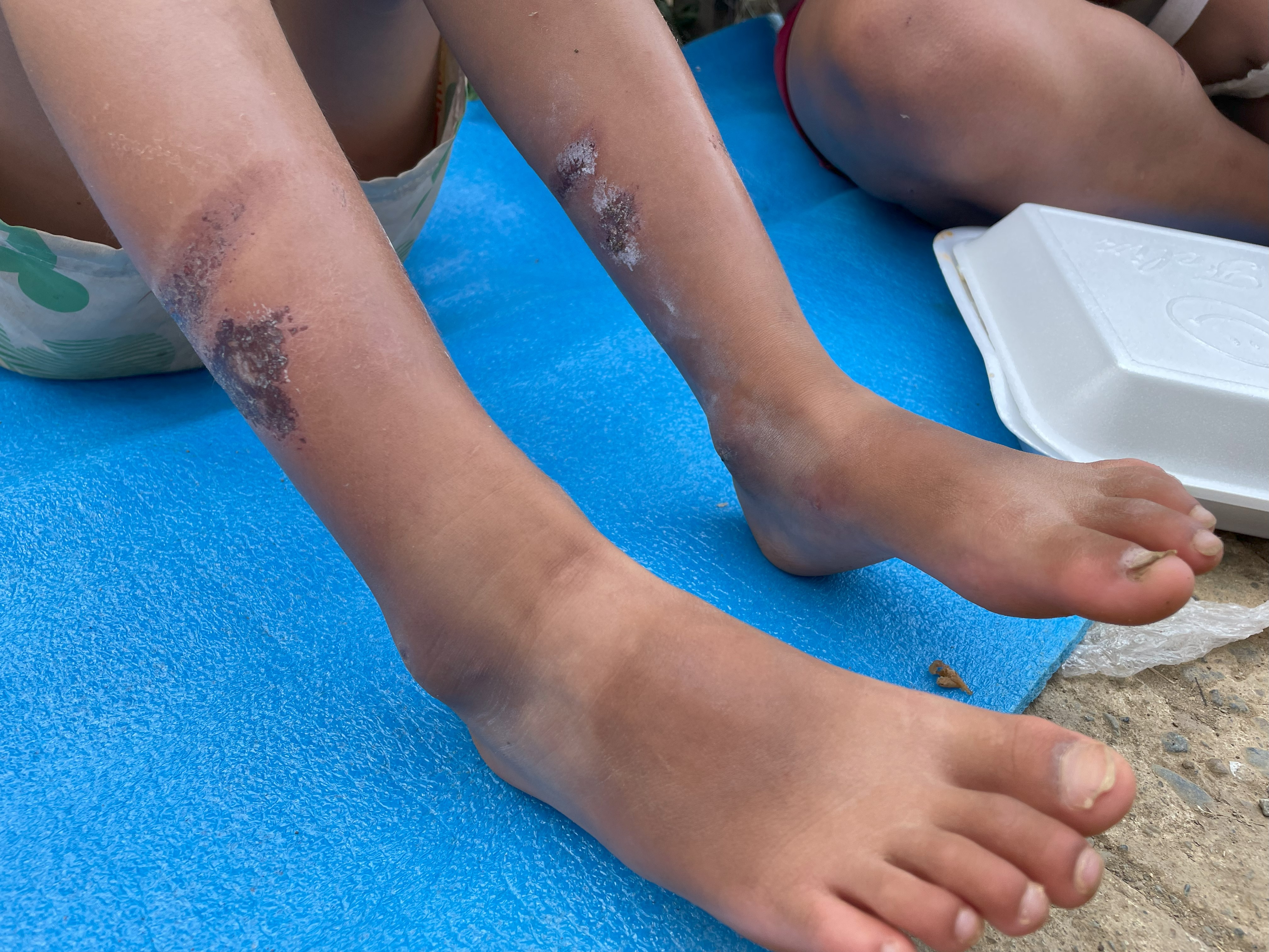 5-year-old girl has sores on her legs from the plastic boots she wore