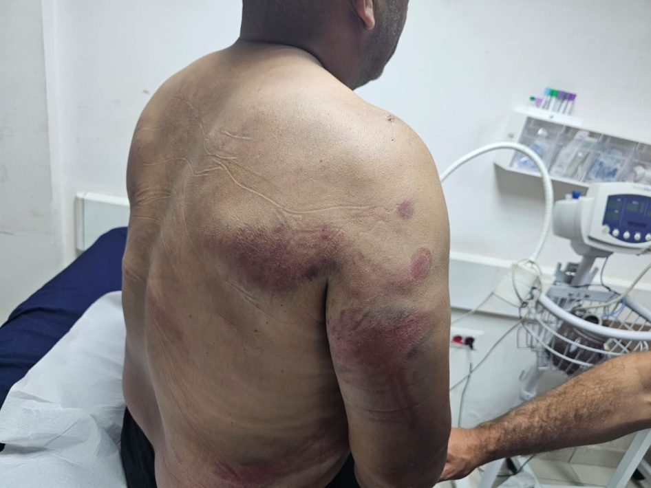 Bruising on one of the men attacked by settlers and active-duty soldiers, in Wadi al-Seeq on October 12, 2023. The man was hospitalized for his injuries.