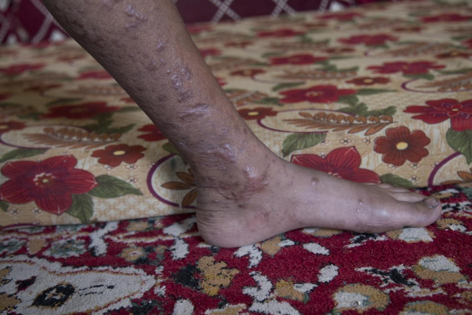 Scars on the leg of Aqil, 12, from an explosion that happened when he and four cousins were walking across a bridge on their way to a local swimming pool in June. 