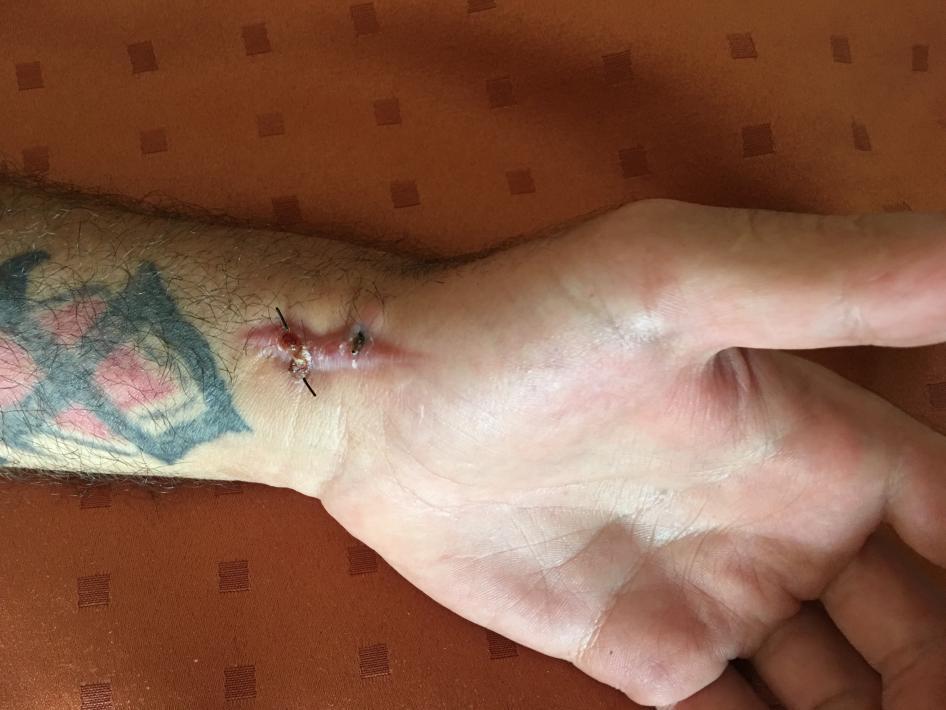 马苏德（化名）的手腕被一名巴布亚新几内亚马努斯岛的本地居民持刀划伤，2017年7月。因为澳大利亚的离岸审查政策，马苏德已被关在巴新四年。
