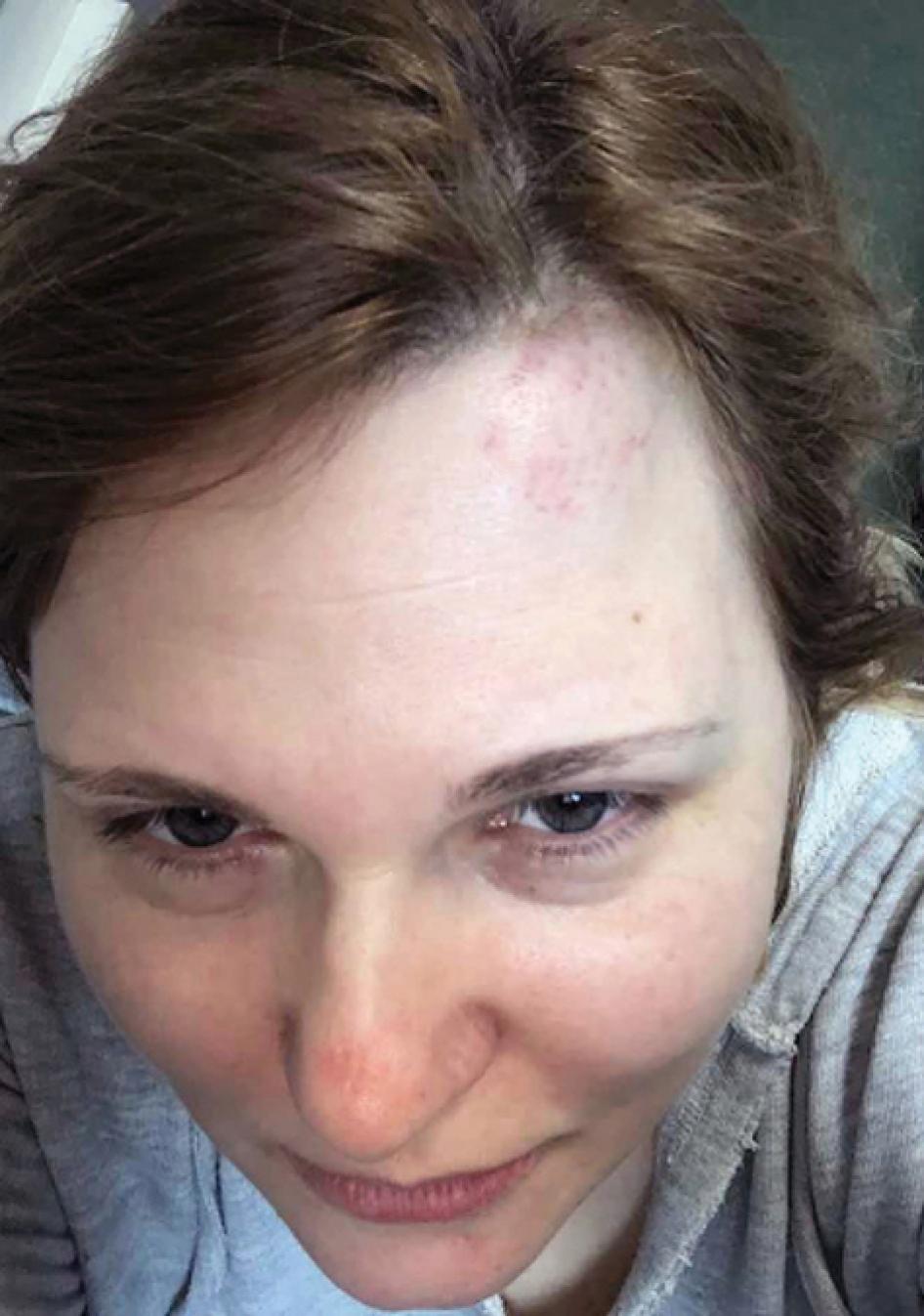 La journaliste russe Elena Milashina, collaboratrice de Novaya Gazeta, photographiée après avoir été agressée à Grozny, en Tchétchénie, en février 2020.