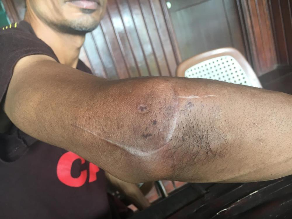 Jahim (not his real name) has spent more than four years on Papua New Guinea’s Manus Island under Australia’s offshore processing policy. An assailant cut Jahim across his elbow and robbed him of his phone in June 2017. 