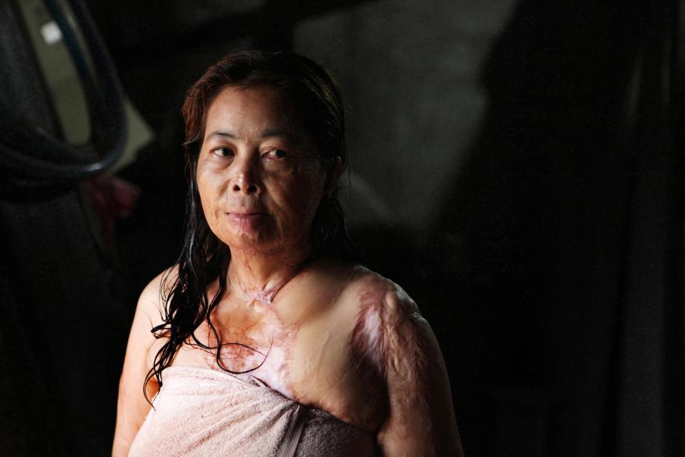 Chantheoun (nom de famille omis), une victime cambodgienne d'une attaque à l'acide perpétrée à Phnom Penh en septembre 1997, photographiée six ans après cette attaque, en 2013.
