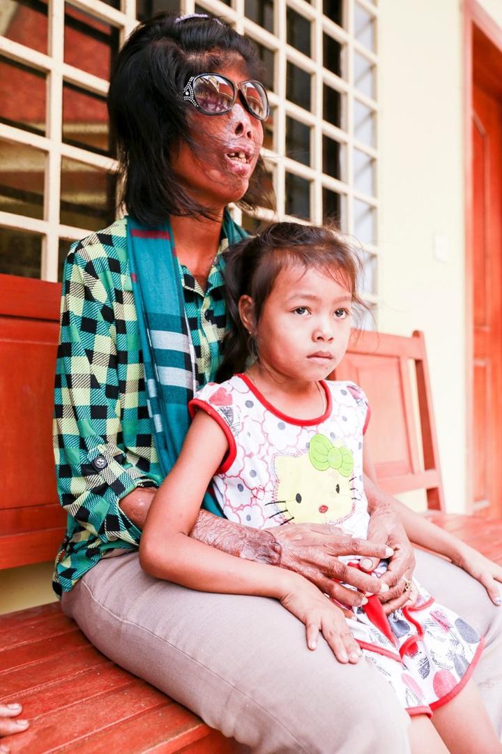Kong Touch, une jeune femme cambodgienne qui a subi une attaque à l'acide le 15 septembre 2011, photographiée avec sa fille devant le siège de la Cour suprême à Phnom Penh, le 22 juillet 2015.